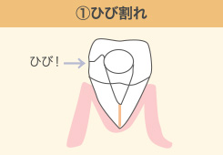 ひび割れ