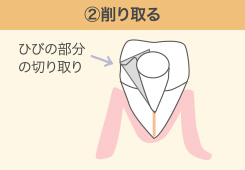 削り取る