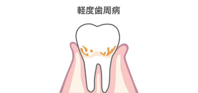 軽度歯周病